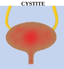 infection urinaire, infection de la vessie, infection de l’urètre, inflammation