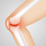 ARTHROSE : soulager naturellement les douleurs