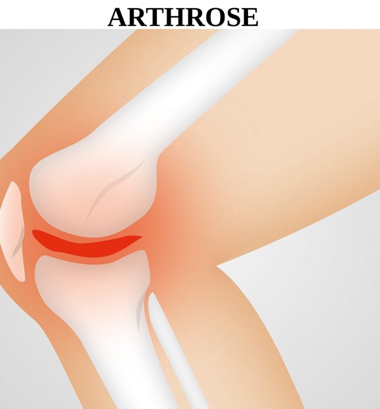 rhumatismes, articulations, cartilage, douleur, inflammation