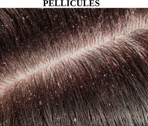 cuir chevelu démangeaisons dermatite séborrhéique